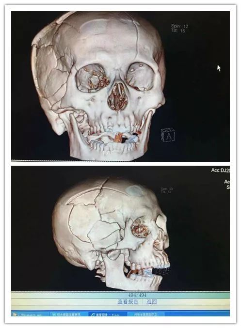 生死一线 重度颅脑损伤抢救纪实!_伤者