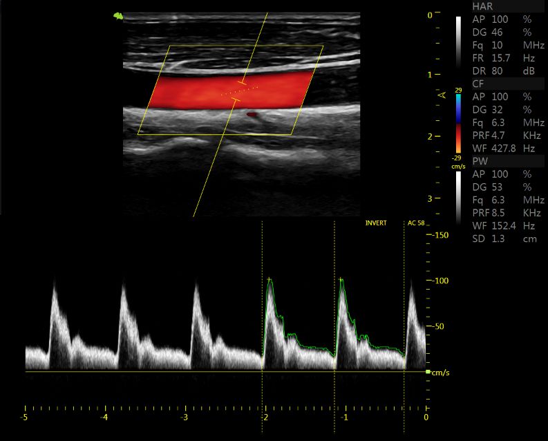 颈动脉超声临床扫描图