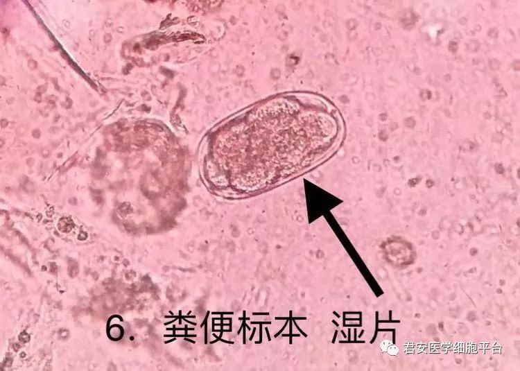6形态特征:上皮细胞上黏附大量细小球杆菌(加特纳菌),使细胞边缘不整