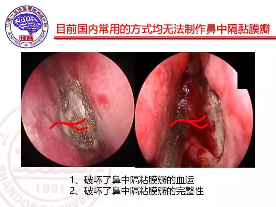 蝶窦癌图片