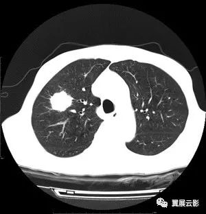肺癌核磁共振图片图片