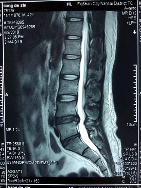 辅助检查 腰椎mri(外院 2018