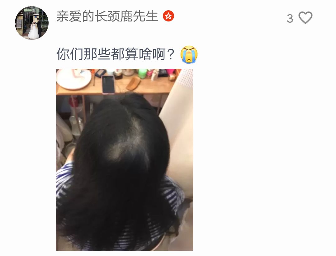 后脑勺秃中分线秃鬓角秃发际线秃大家都秃的各具特色看到大家都秃了我