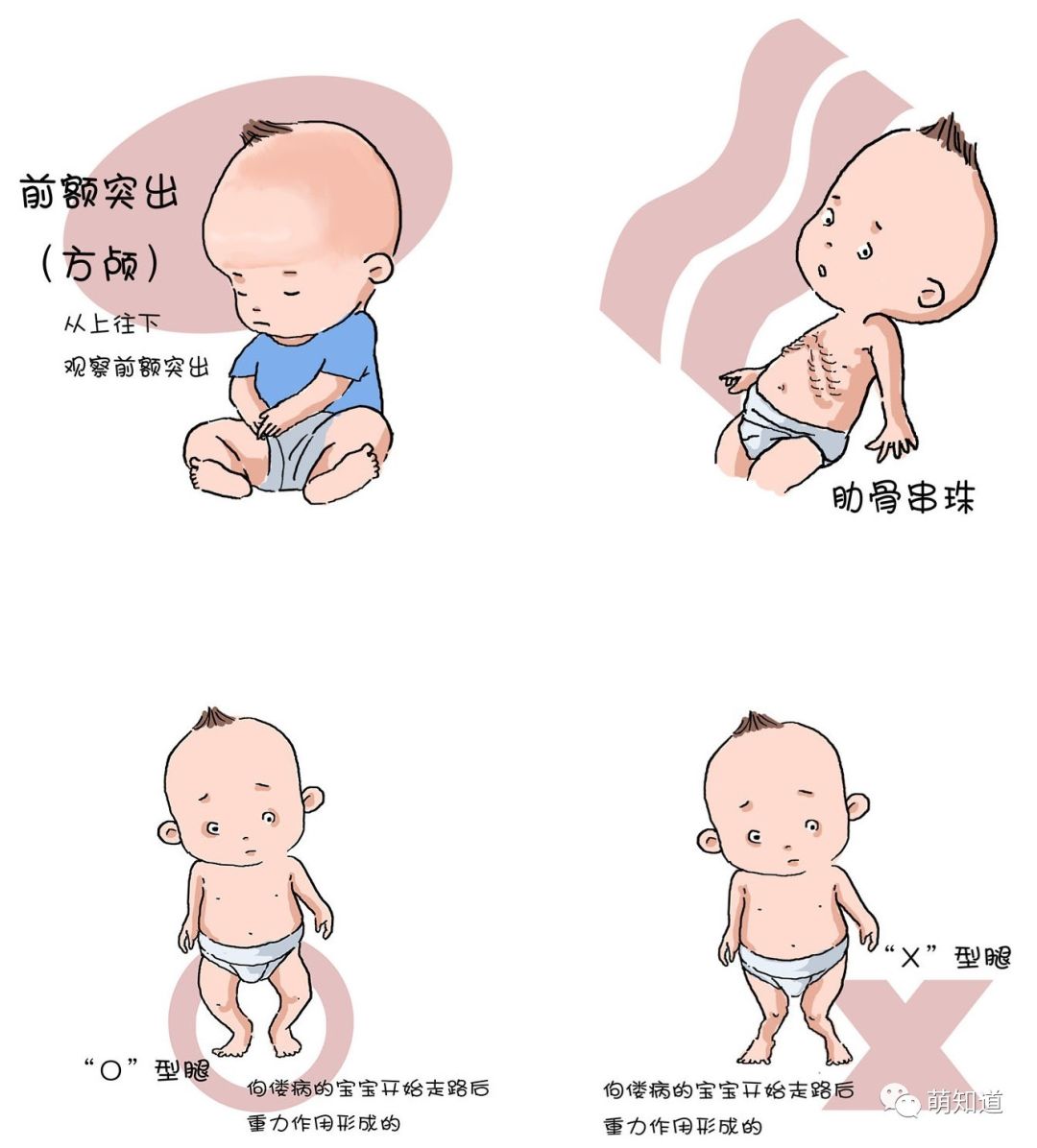 宝宝肋骨串珠症状图图片