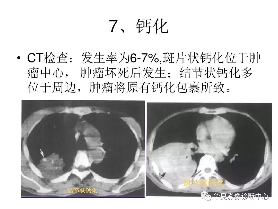 3分鐘教會你肺癌常見的7大ct影像特徵