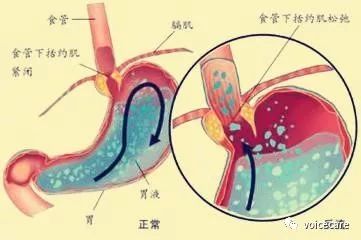 歌手演員如何避免胃酸反流所致的喉嚨不適和嘶啞