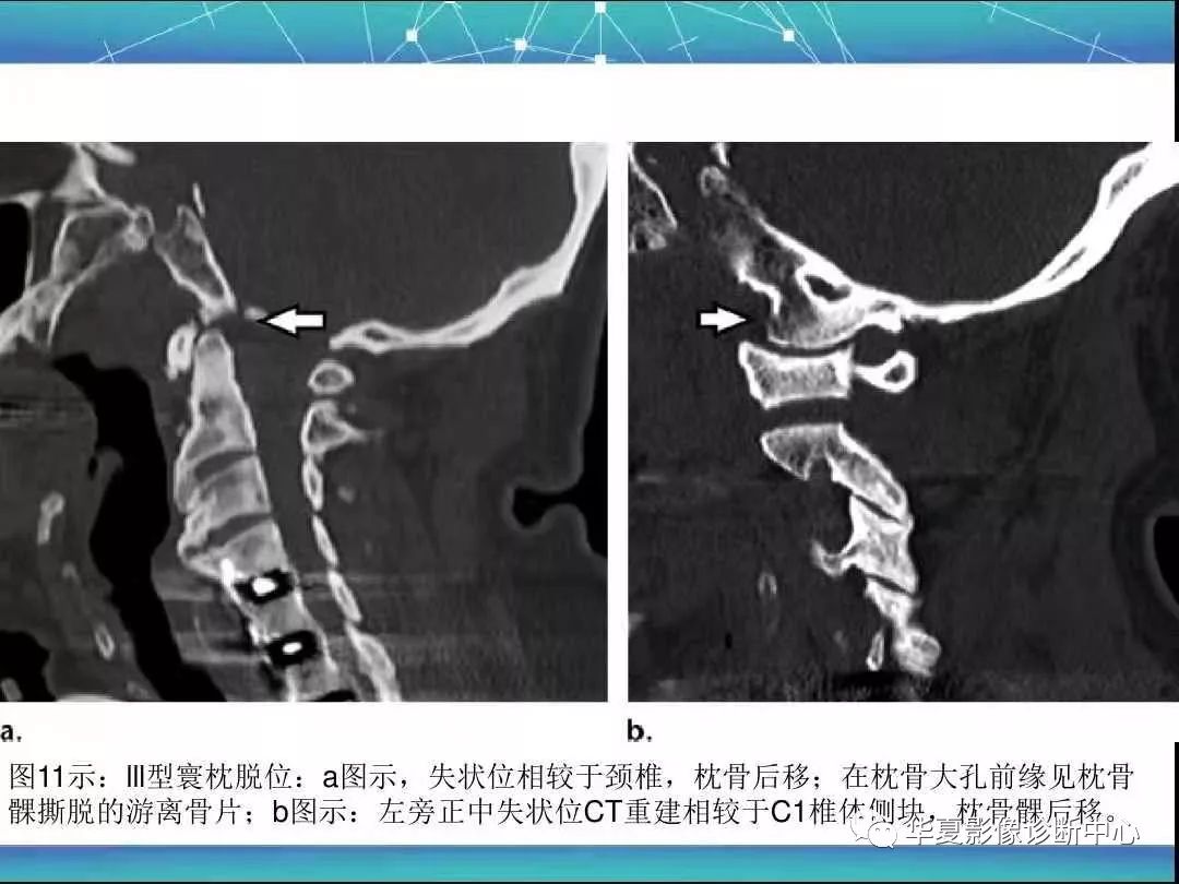 寰枕及寰樞關節外傷的影像學表現