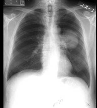 肺癌的影像学图解
