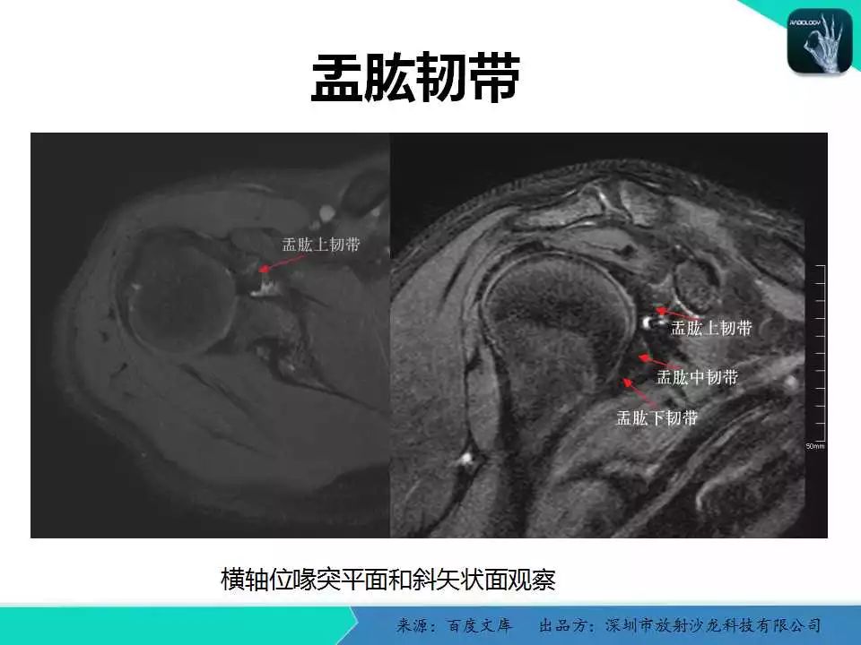 精品課件肩關節病變mri解剖和診斷