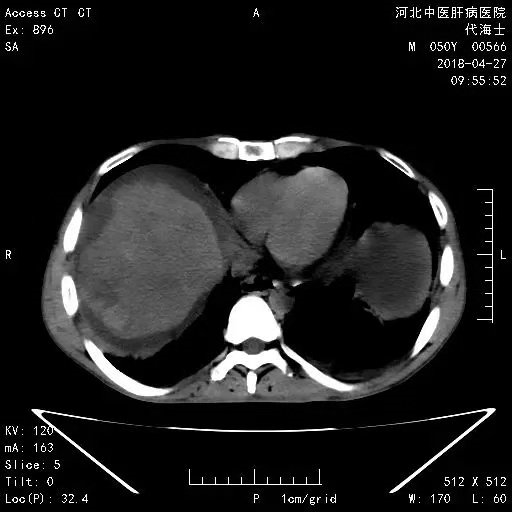 赞肝癌破裂出血急诊介入治疗半小时救命