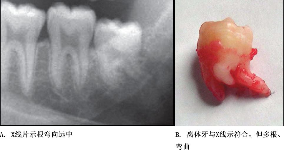 牙根阻力以多根牙,根分歧过大,特长根,u形根,牙颈部倒凹大者阻力较大