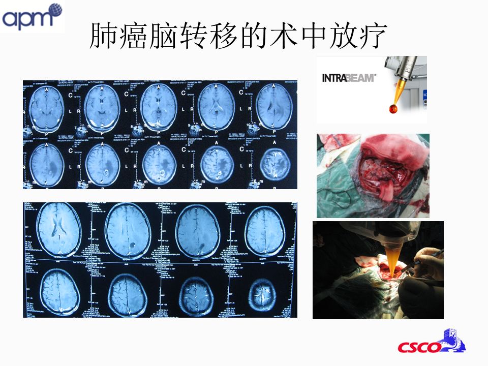 cns2018天壇普華醫院韓小弟腦腫瘤的手術中局部弱x線放射治療112例