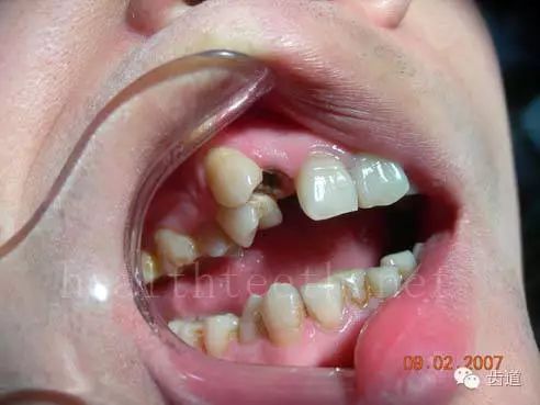 嘴巴里很多牙齿的照片图片
