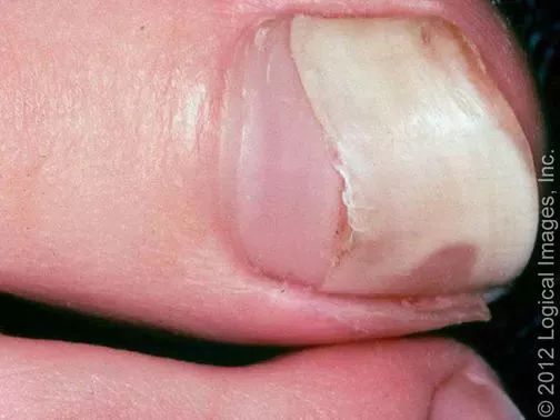 指甲有白点肚子里有蛔虫月牙越大越健康指甲软是缺钙这些都是真的吗