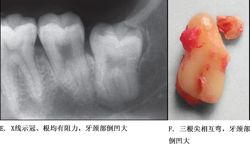 根分歧过大,特长根,u形根,牙颈部倒凹大者阻力较大(图9)根尖区以近中