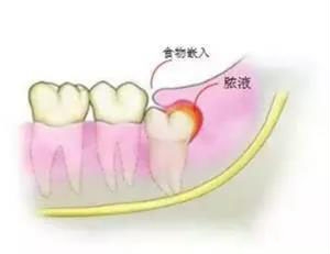 智齒萌出時,空間不足引起冠周炎症