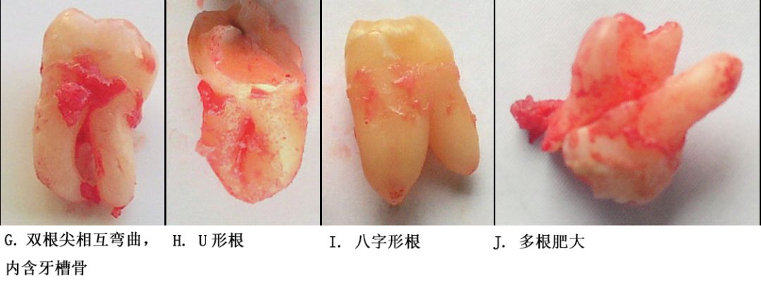 牙根阻力以多根牙,根分歧过大,特长根,u形根,牙颈部倒凹大者阻力较大