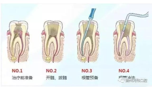 根尖周炎的治疗方法图片