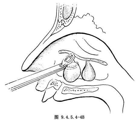 鼻息肉手绘图图片