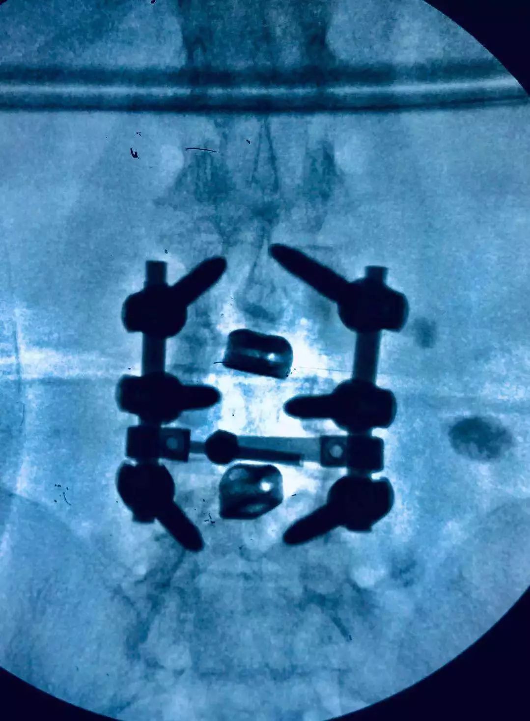 術中c-型臂透視腰椎正位片術中c-型臂透視腰椎側位片供稿:淄博市第一
