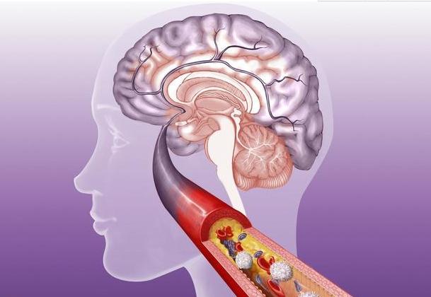 在日常生活中腦梗塞是中老年人易發的病症,複發率高,致殘率高,死亡率