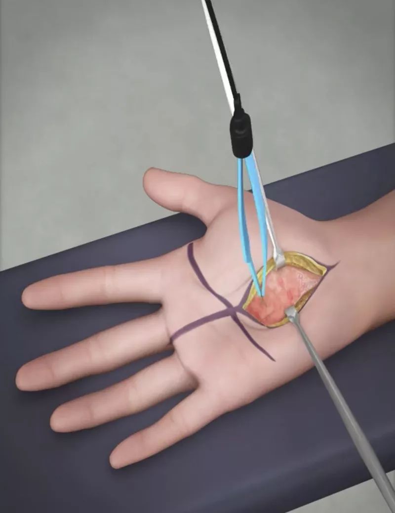 腕管综合征手术关键步骤3d模拟展示