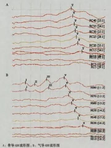 聽力診斷骨導abr