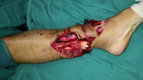 车祸导致小腿离断再植手术成功保肢