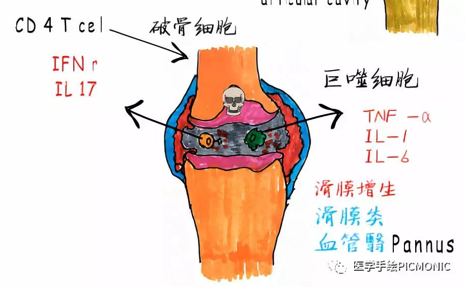 类风湿性关节炎机制图片