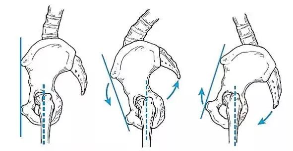 图5 骨盆倾斜侧面观前倾时:腰骶角增大;腰椎生理弯曲增大;髋关节屈曲