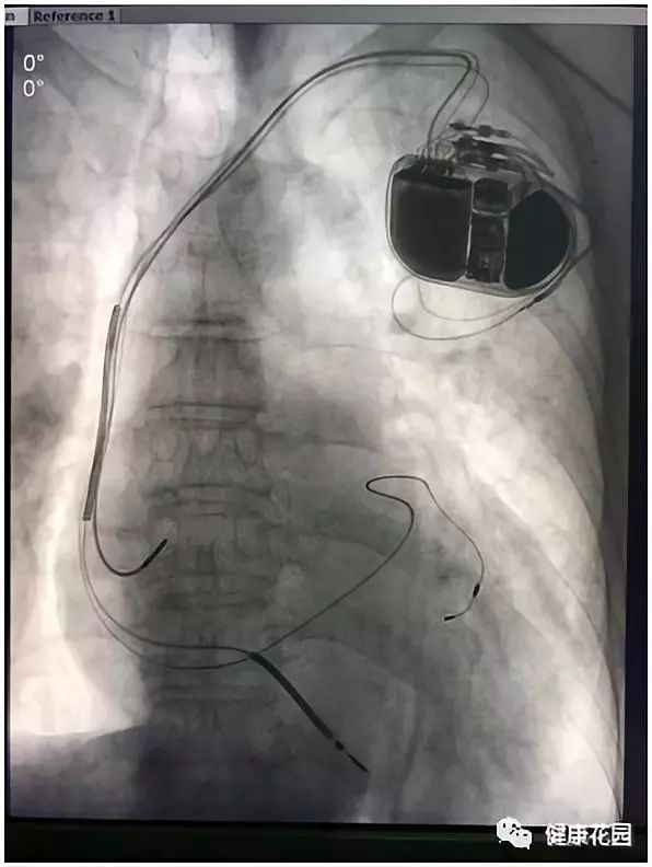 三腔起搏器 植入图片