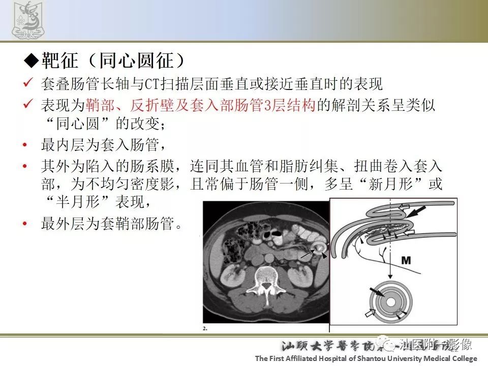 肠套叠影像学诊断