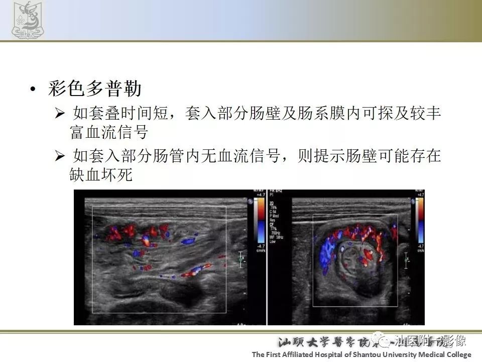 肠套叠影像学诊断