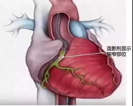 心脏支架图片位置图片