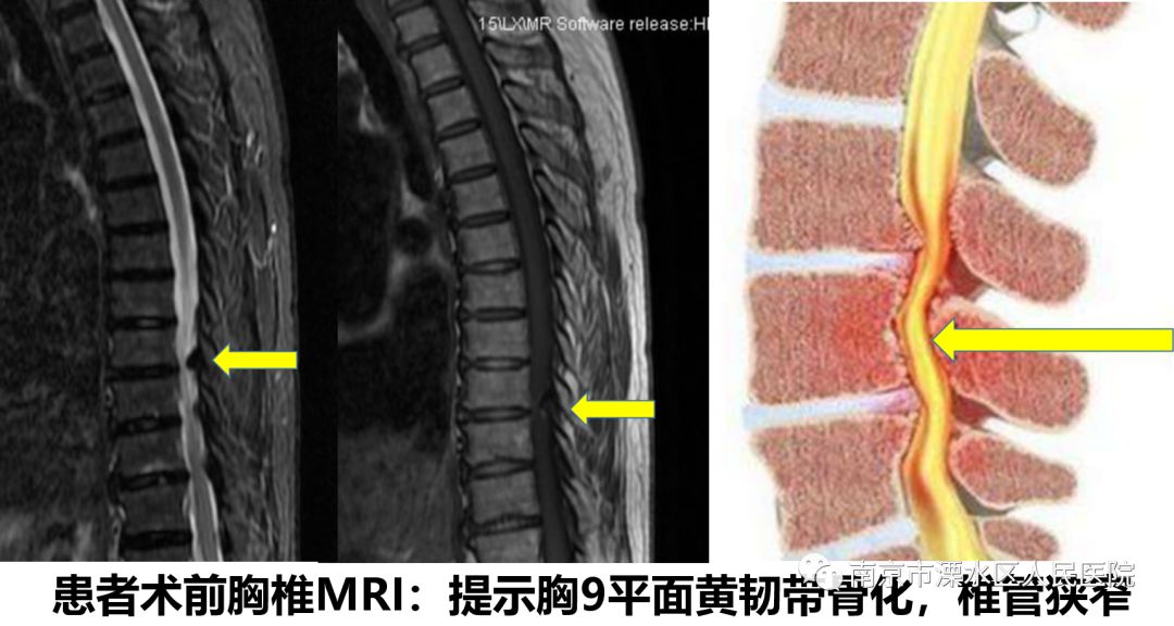 黄韧带增厚核磁图片图片