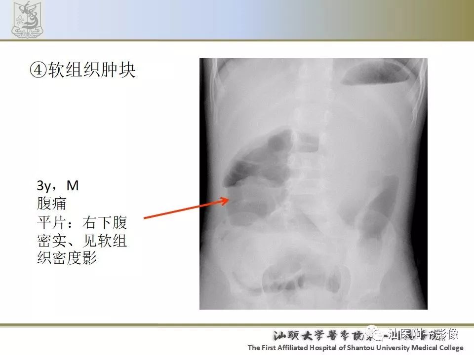 肠套叠x线表现杯口征图片