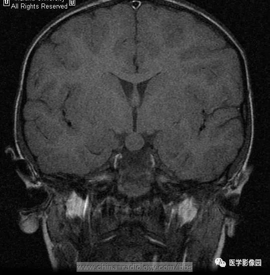 下丘脑错构瘤图片