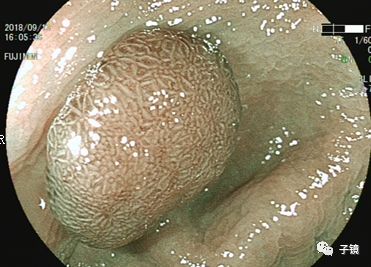 结肠绒毛管状腺瘤图片