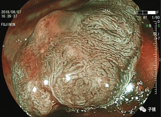 此例乙状结肠粗蒂息肉,子敬感觉切得很完整,但病理提示高分化癌变