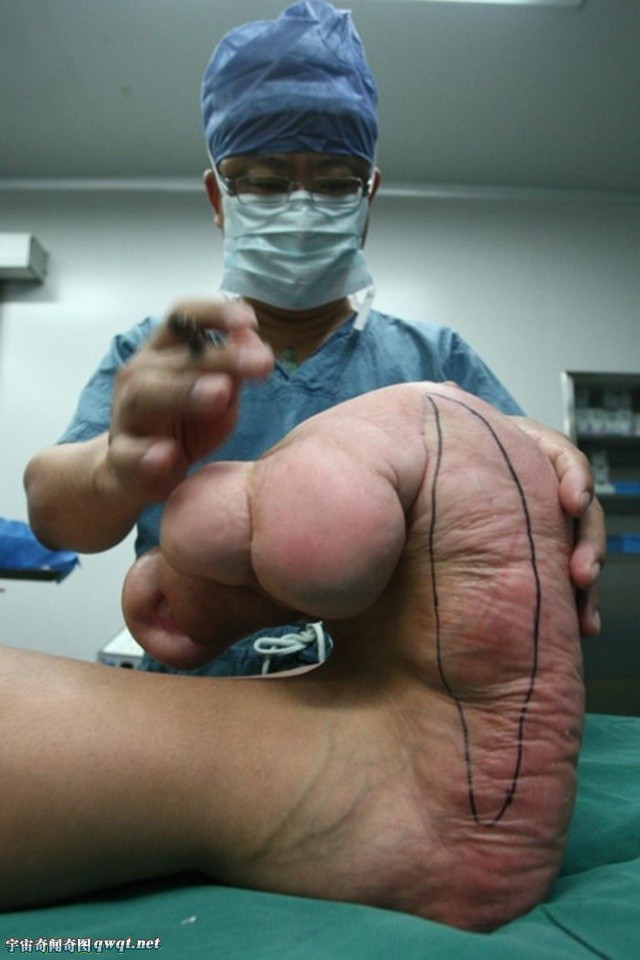 广西瑶族14岁男童患罕见大脚症巨足脚趾大如小腿