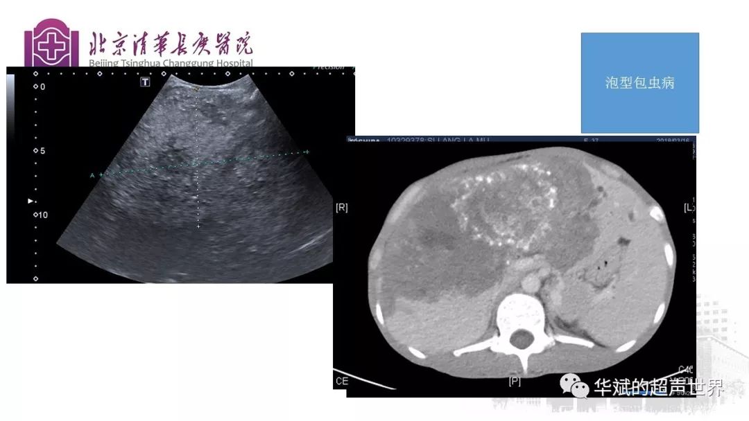 文献与病例学习肝包虫病的超声诊断