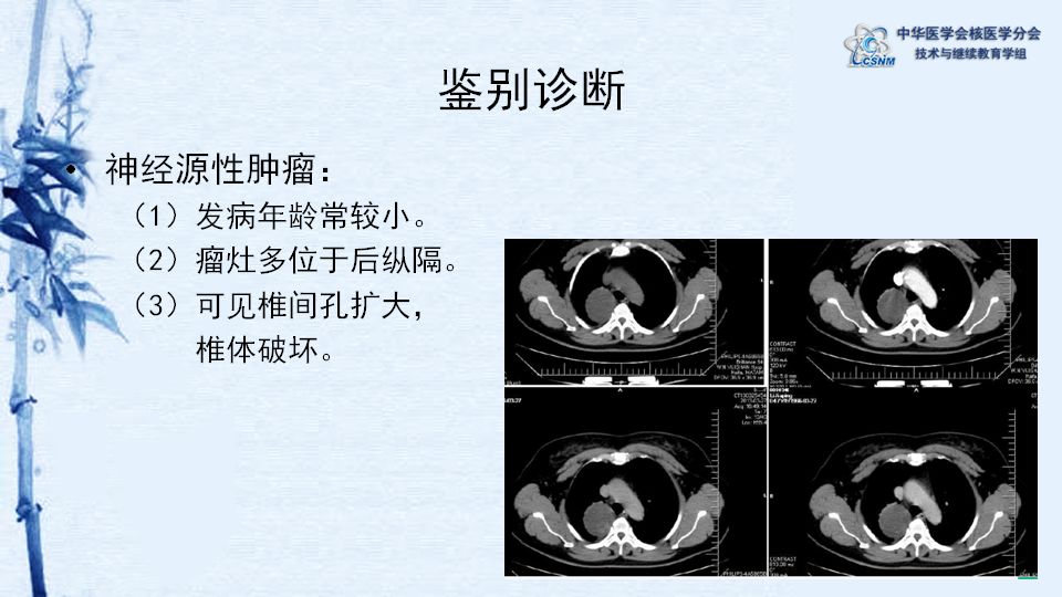 病例18期李鳳歧胸腺瘤petct顯像一例