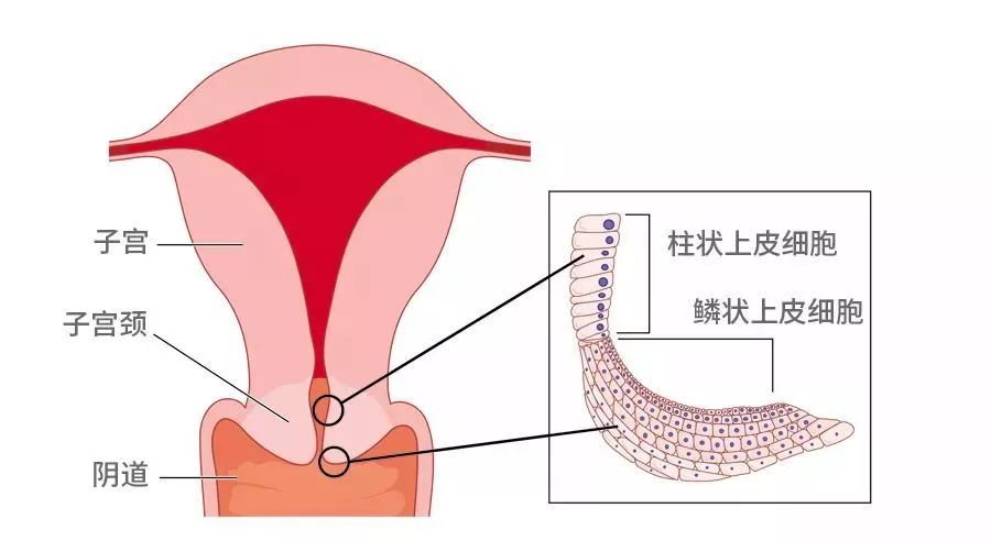 宫颈糜烂是由于在雌激素的作用下,宫颈管内的柱状上皮长到宫颈外口的