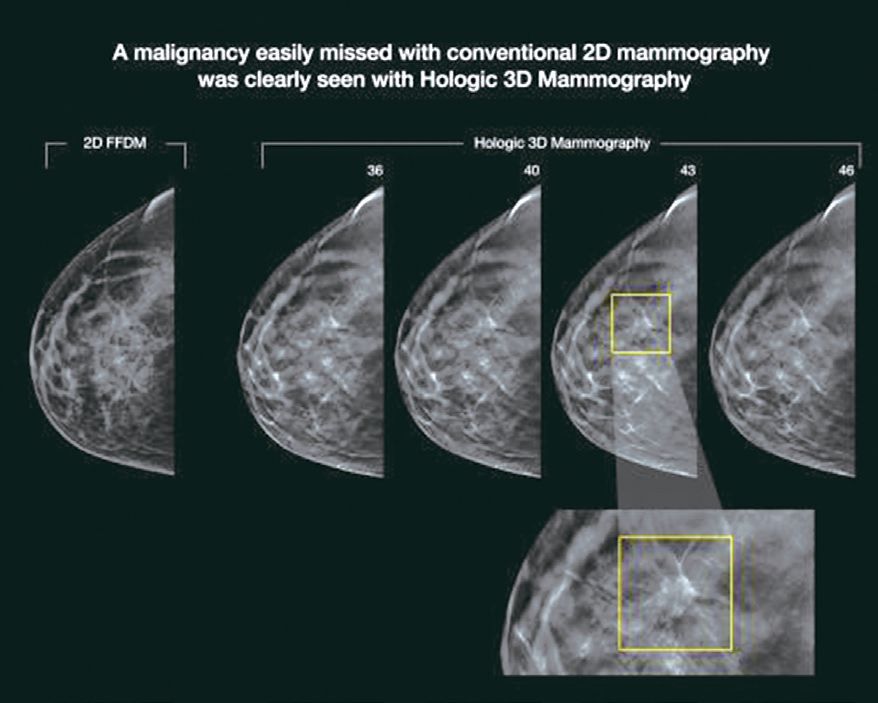 研究表明3d钼靶是更准确的乳腺癌筛查方法