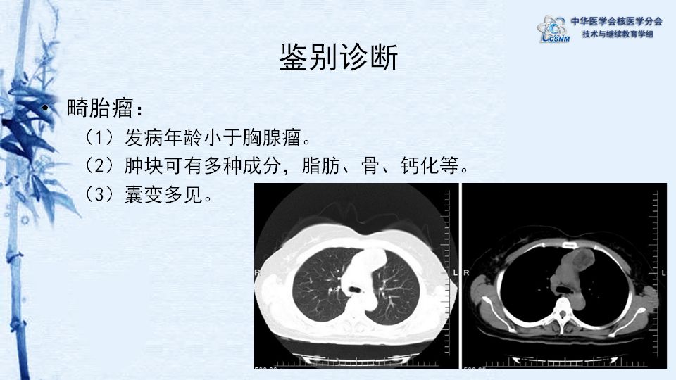 病例18期李鳳歧胸腺瘤petct顯像一例