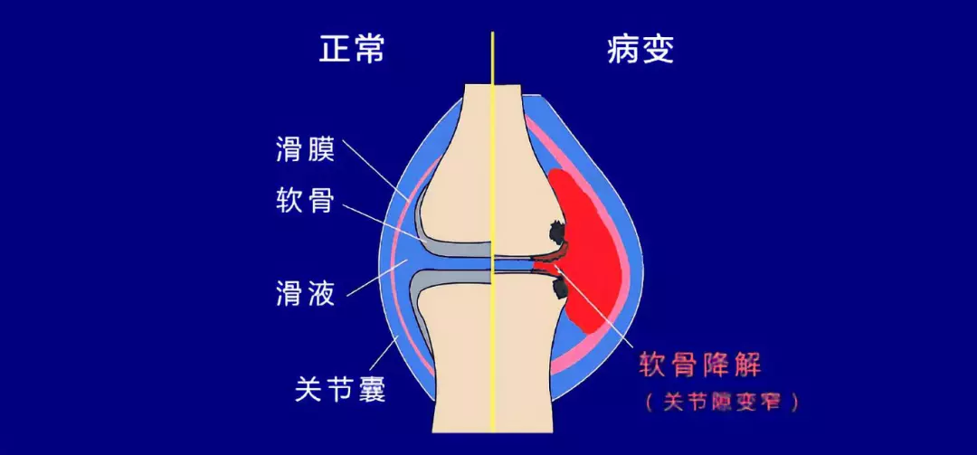 疼痛病的那些事兒 | 膝關節不可承受之重,且行且珍