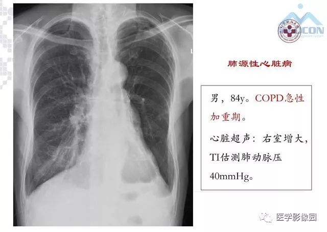 肺动脉高压胸片表现图片