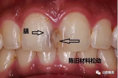 门牙龋坏,树脂修复一例