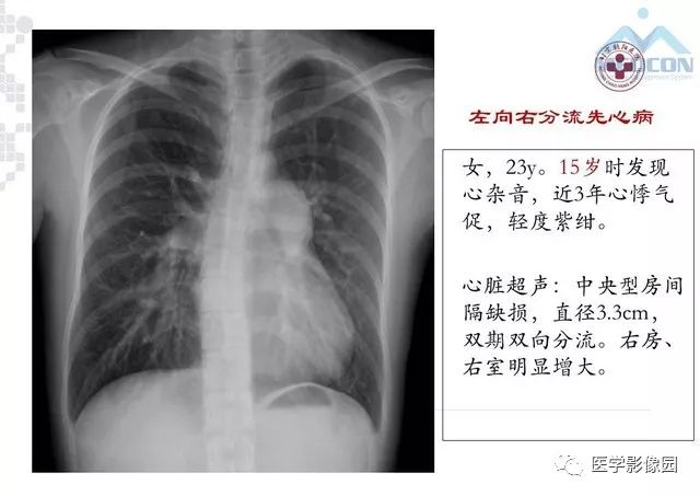 肺动脉高压胸片表现图片