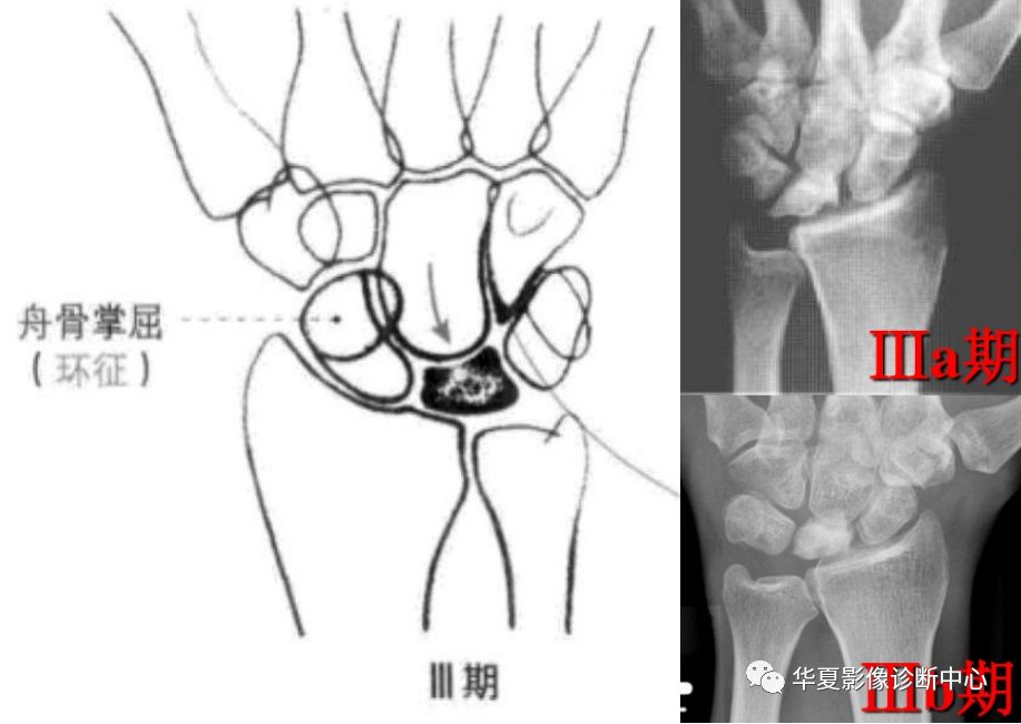 月骨是哪个位置图片图片